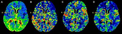 Association between enlarged perivascular spaces in basal ganglia and cerebral perfusion in elderly people